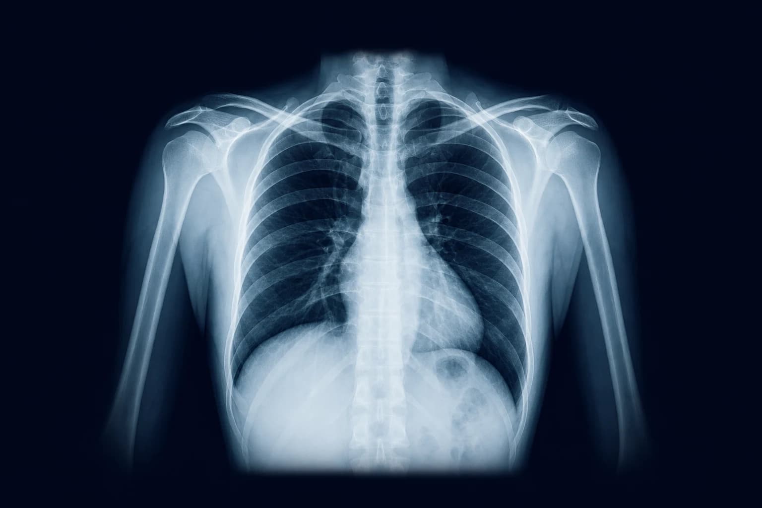 Frontal chest radiograph used as a teaching image
